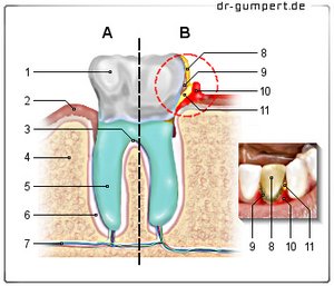Abbildung Zahnfleischentzündung