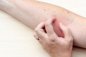 Hautausschlag nach Antibiotika