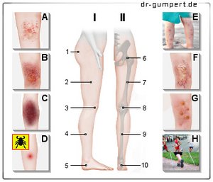 Abbildung rote Flecken an den Beinen: Ursachen und Beispiele