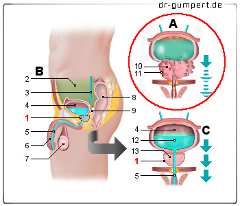Schematische Darstellung Prostatakrebs