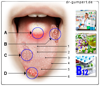 Schematische Darstellung Rote Flecken auf der Zunge
