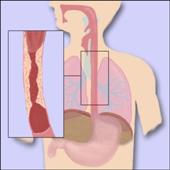 Abbildung Speiseröhre Tumor