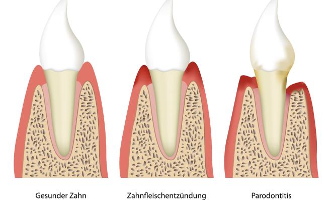 Parodontitis und Parodontose 
