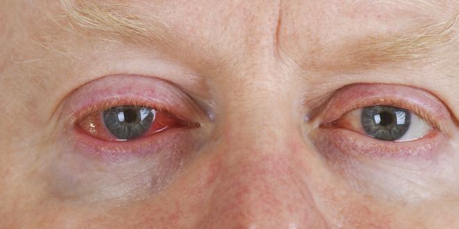 gerötete Augen - Augenentzündungen