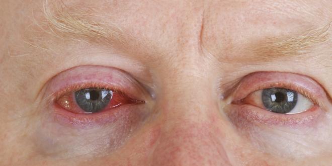 Gerötete Augen bei einer Bindehautentzündung