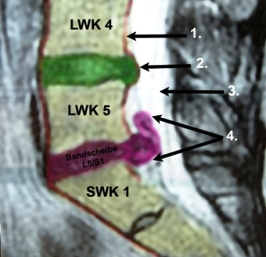 Nucleus pulposus prolaps
