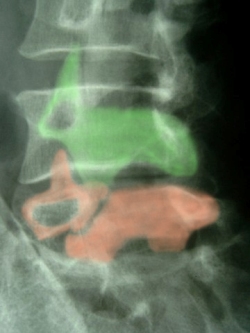 Spondylolyse