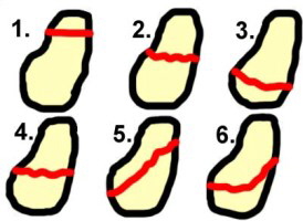 Kahnbeinbruch