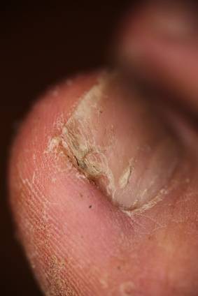 Onicholisis auf den Nägeln die Präparate für die Behandlung