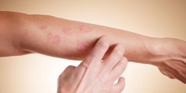 Kontaktdermatitis am Arm