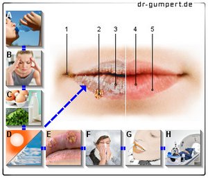 Abbildung trockene Lippen