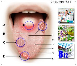 Abbildung rote Flecken auf der Zunge