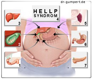 Abbildung: Oberbauchschmerzen in der Schwangerschaft