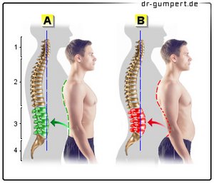 Abbildung Lordose und Hyperlordose