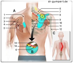 Abbildung Schmerzen im Schulterblatt