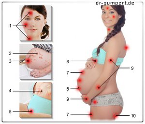 Abbildung Hautausschlag in der Schwangerschaft