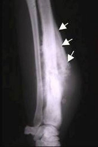 Osteosarkom