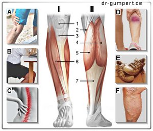 Abbildung Schmerzen am Unterschenkel