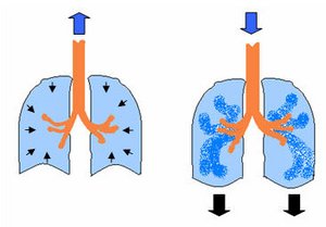 Atmung bei Asthma