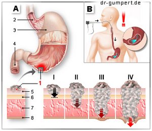 Abbildung Magenkrebs
