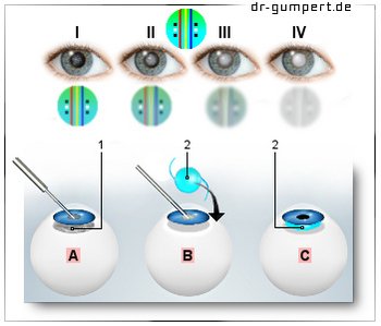 Abbildung Katarakt (grauer Star)-Operation Abbildung Katarakt (grauer Star)-Operation
