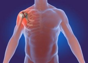 Eine Arthrose im Schultergelenk kann zum Beispiel nach einer Verletzung des Gelenkes auftreten.