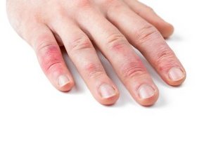 Hautausschlag an den Fingern