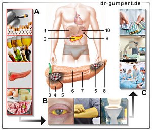 Abbildung Bauchspeicheldrüsenkrebs