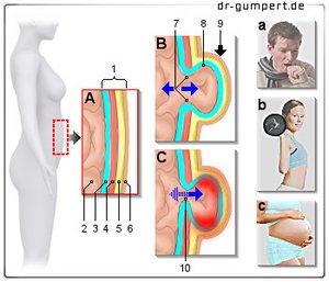 Symptome eine Nabelbruchs