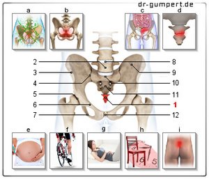 Abbildung Steißbeinschmerzen