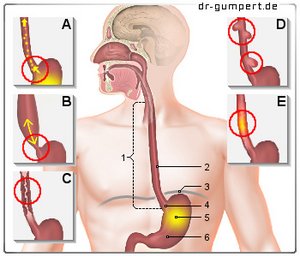 Abbildung Schmerzen an der Speiseröhre