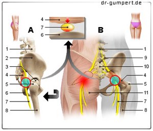 Abbildung Piriformis-Syndrom