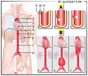 Abbildung Aortenriss