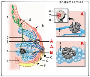 Abbildung Brustkrebs
