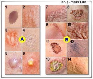 Abbildung Hautveränderungen
