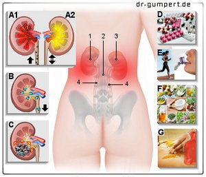 Abbildung Nierenschmerzen
