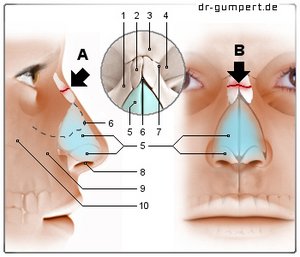 Abbildung Nasenbeinbruch