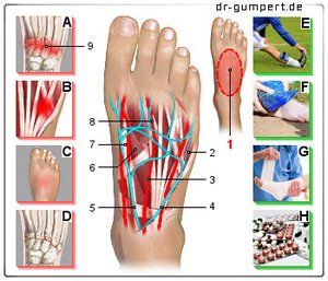 Abbildung Schmerzen am Fußspann