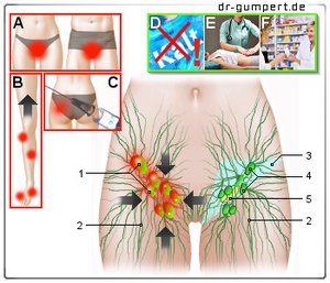 Abbildung Lymphknotenschwellung in der Leiste