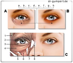 Abbildung von Augenringen