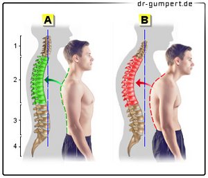 Abbildung Kyphose und Hyperkyphose