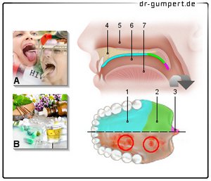 Abbildung rote Flecken am Gaumen