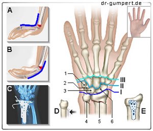 Abbildung Handgelenksbruch