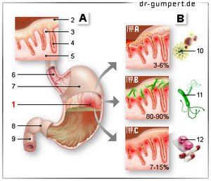 Abbildung Magenschleimhautentzündung/Gastritis