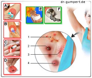 Achseln den knubbel unter Geschwollene Lymphknoten