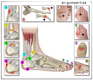 Abbildung Fußschmerzen