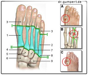 Abbildung Schmerzen in den Mittelfußknochen