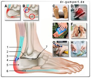 Fersenschmerzen