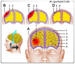 Abbildung Hirnblutung