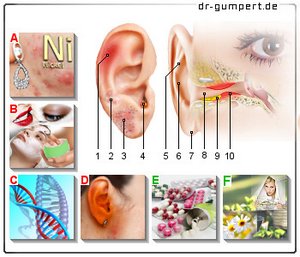Abbildung Ekzem im Ohr